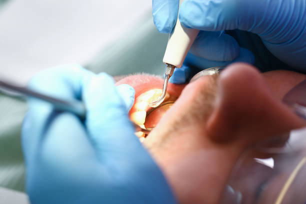 Best Emergency Tooth Extraction in Arden Arde, CA