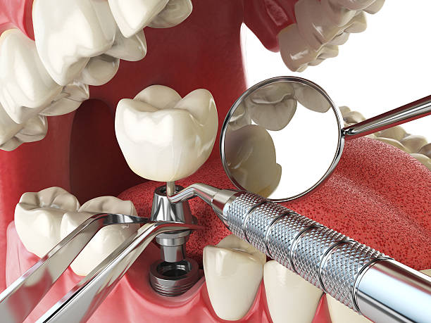 Best Emergency Tooth Extraction in Arden Arde, CA